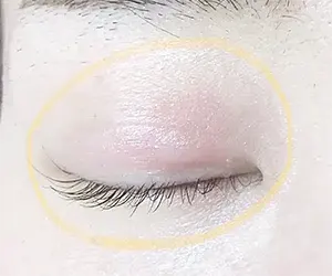 まぶたのかぶれ