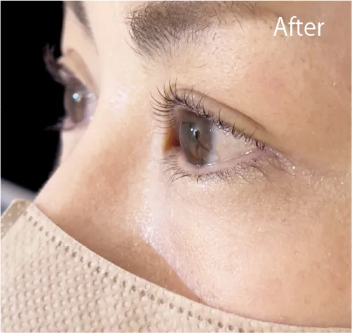 BeforeAfter画像02AIリフトパーマ