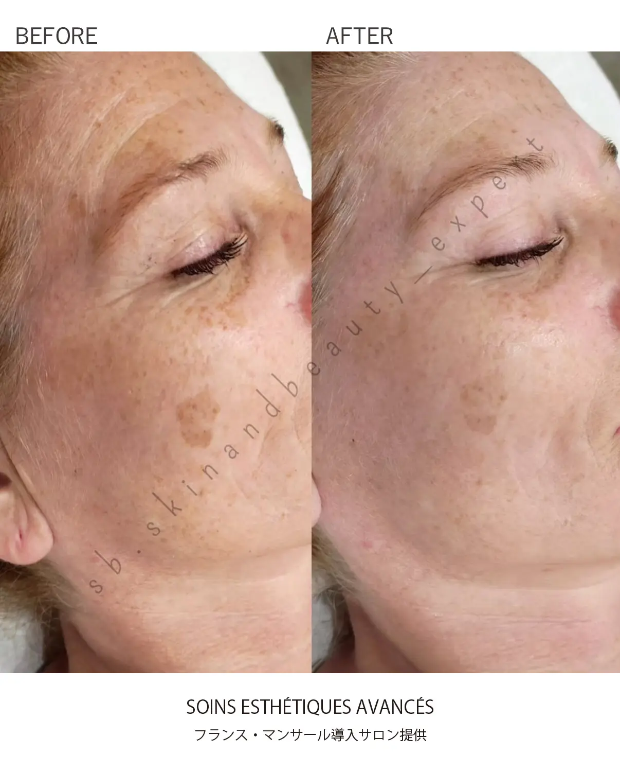 AIコラーゲン再生リフトケア-BeforeAfter画像