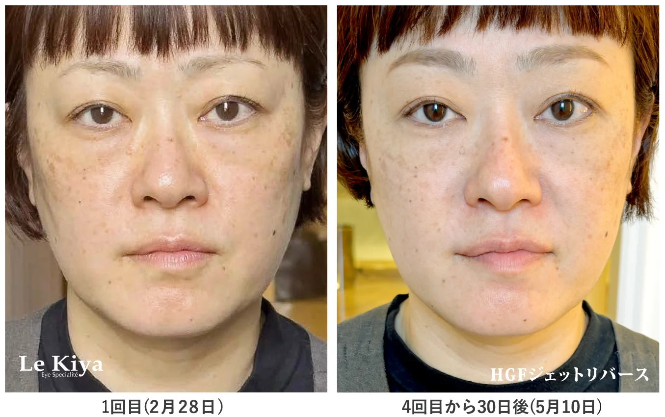 BeforeAfter画像HGFジェットリバース