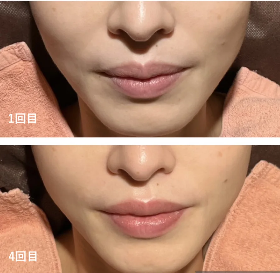 HGFジェットリバース-BeforeAfter画像