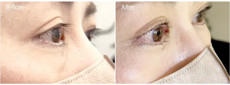 AIリフトパーマ-BeforeAfter画像