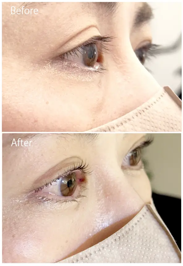 AIリフトパーマ-BeforeAfter画像