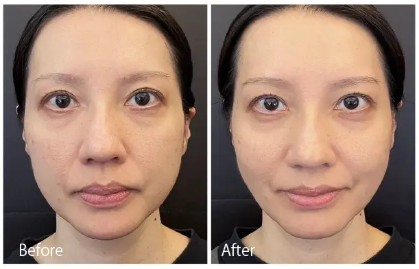 AIリフトパーマ-BeforeAfter画像