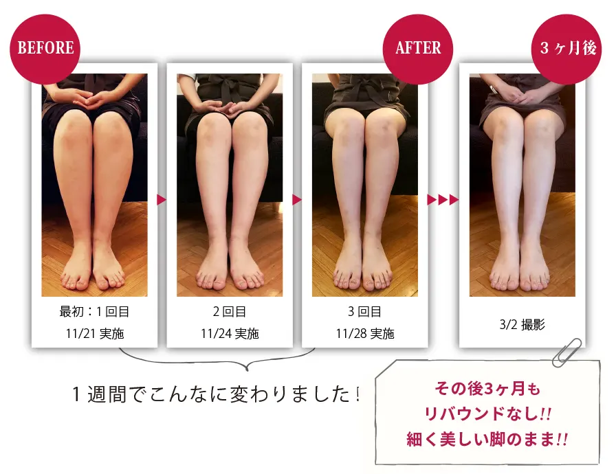 ヴィーナスデザインレッグ-BeforeAfter画像