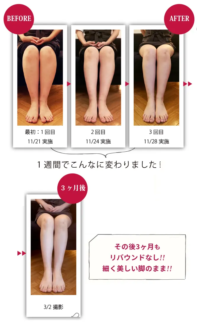 ヴィーナスデザインレッグ-BeforeAfter画像