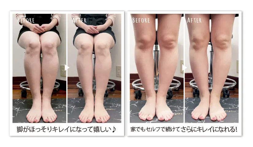 ヴィーナスデザインレッグ-BeforeAfter画像