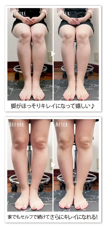 ヴィーナスデザインレッグ-BeforeAfter画像