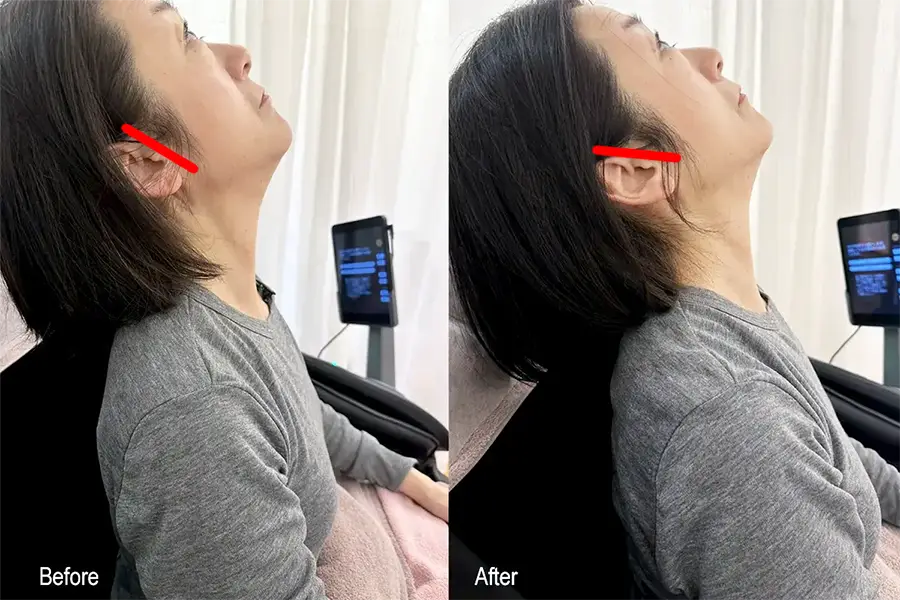 Before / After（首の後屈）