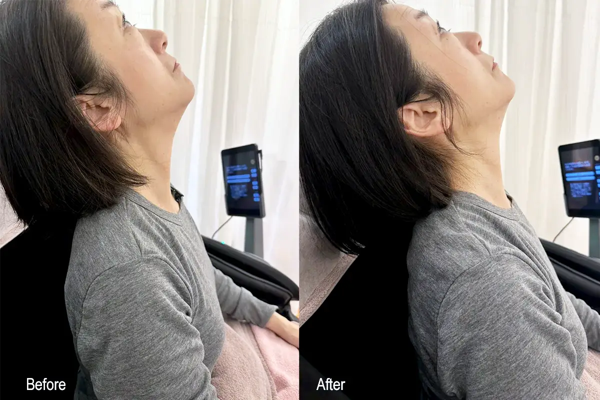 Before / After（首の後屈）