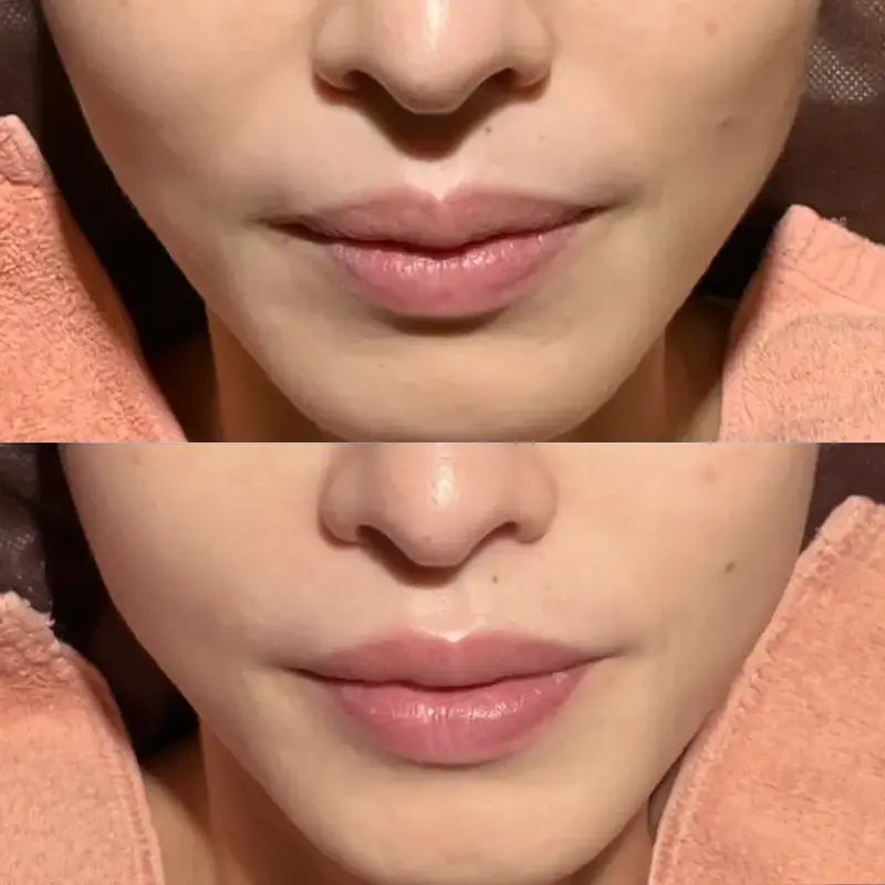 ほうれい線と唇のしわ、ハリ・弾力を気にされていたお客様の声（40代・女性）