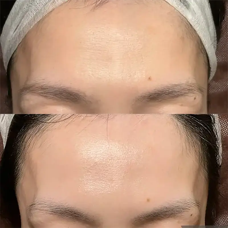 額の深いシワを気にされていたお客様の声（50代・女性）