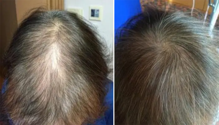 髪が細くなり薄毛を気にされていたお客様の声（69歳・女性）