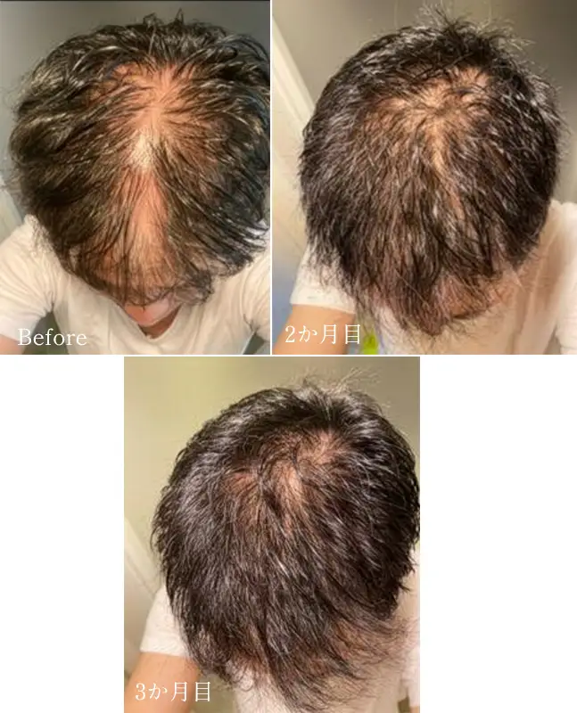 薄毛を気にされていたお客様の声（60代・男性）