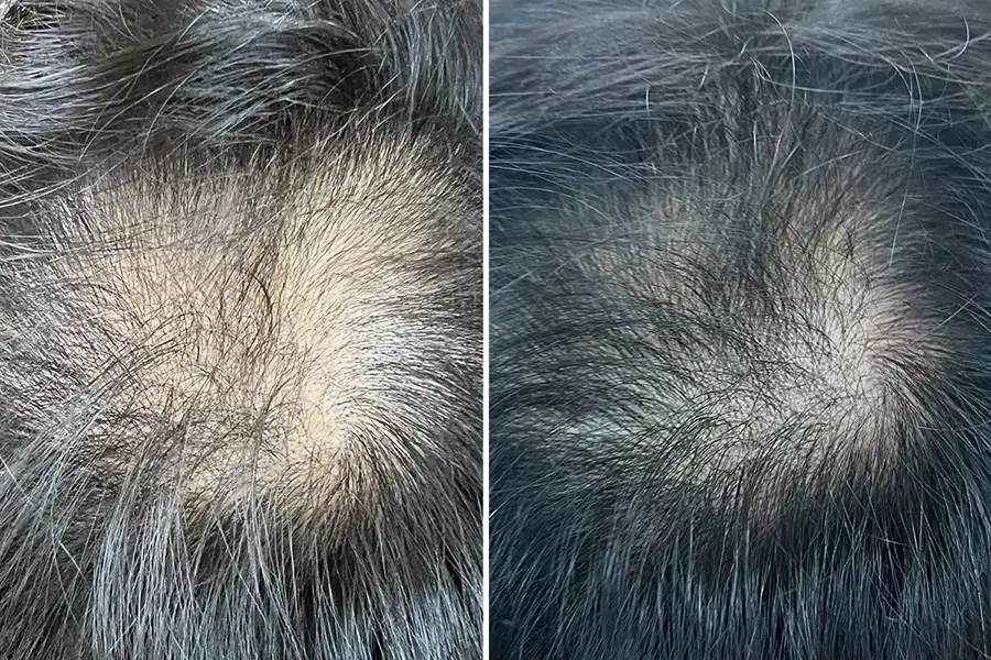 薄毛を気にされていたお客様の声（40代・男性）