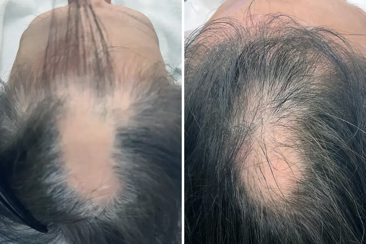 頭皮を整えることで、起きてくること BeforeAfter