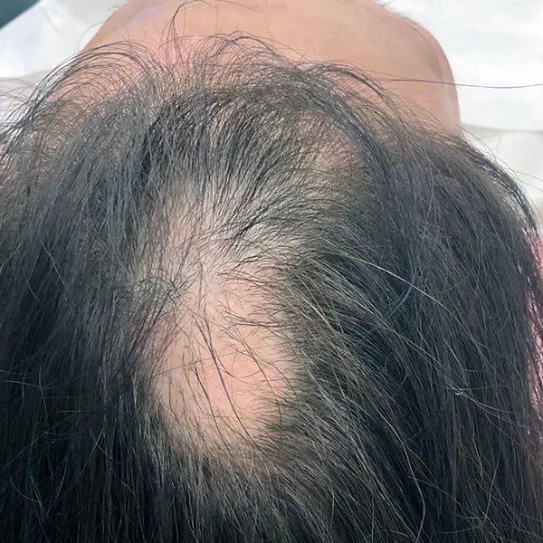 Before / After（首の後屈）